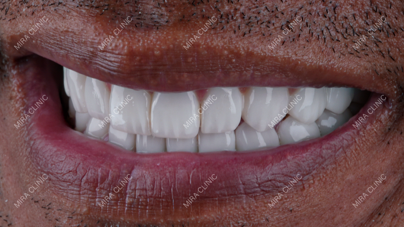 Tooth Coverage Strength and Purpose